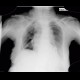 Malposition of central venous line, paravasat, fluidothorax: X-ray - Plain radiograph